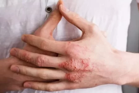 شواهدی مبنی بر افزایش بیماری های پوست و مو در همدان وجود ندارد