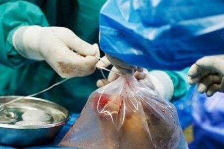 ۵۰ درصد خانواده‌های بیماران مرگ مغزی به اهدای عضو رضایت نمی‌دهند